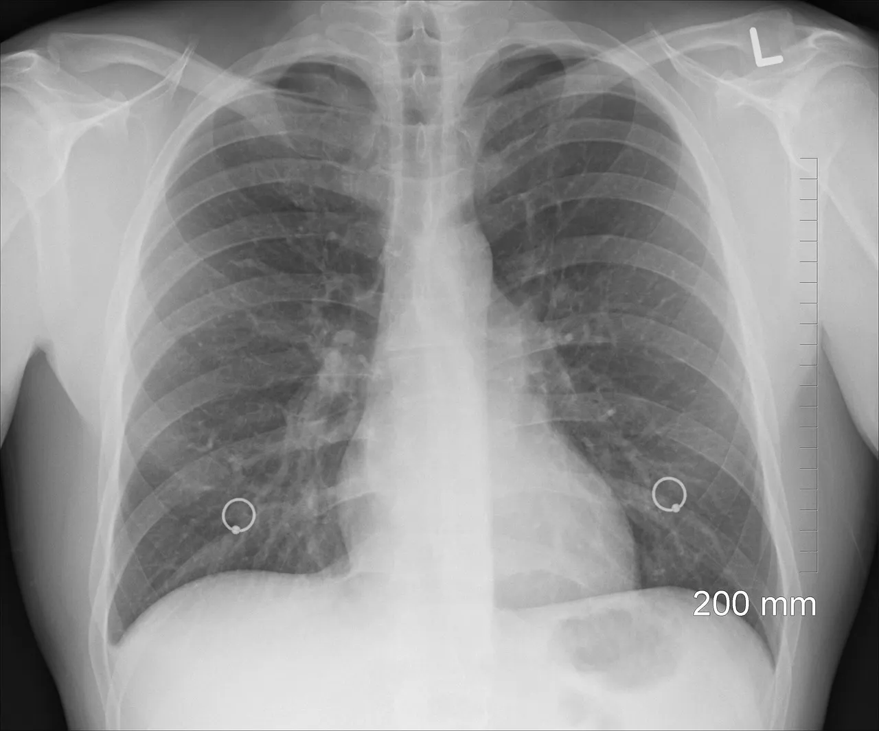 A chest X-ray showing the ribcage and spine