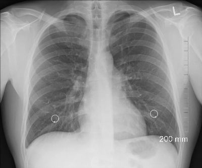 diagnosis, xray, chest, lungs, ribs