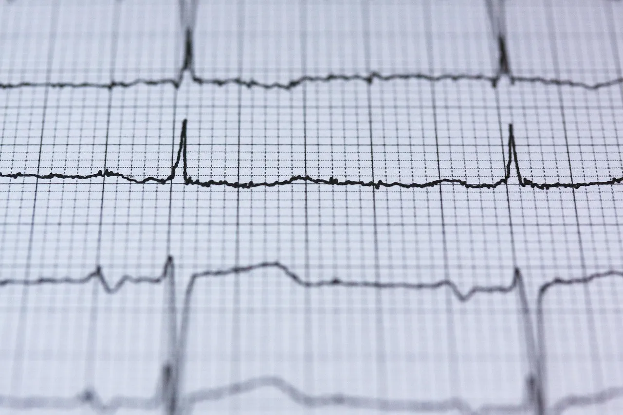 An electrocardiogram trace printed on graph paper