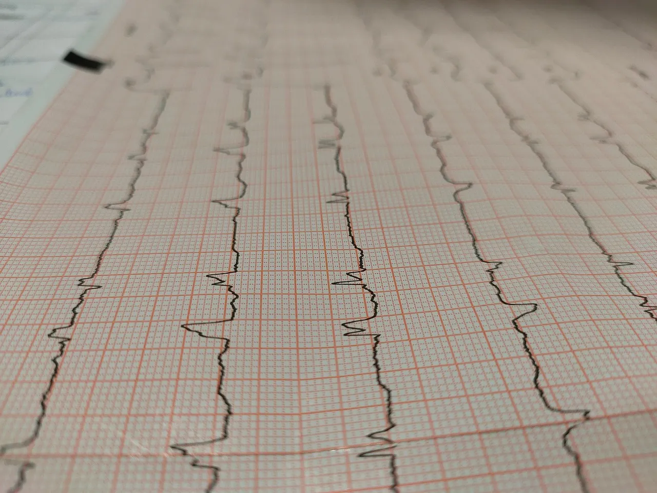 A printed electrocardiogram strip on pink grid paper